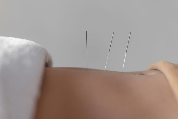 Acupuntura